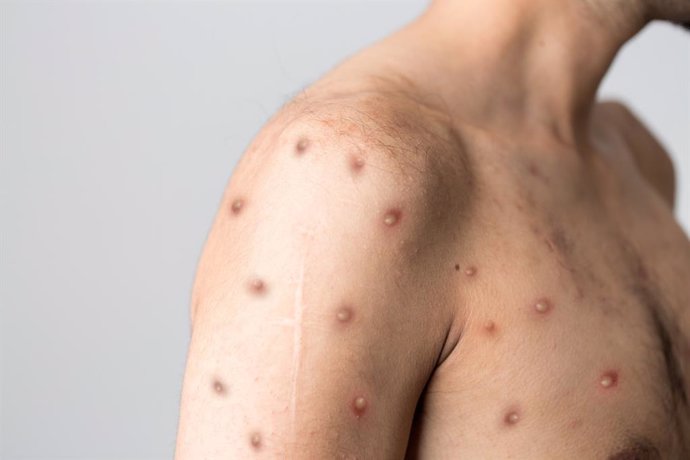 Recomendaciones de Salud Pública ante alerta de la OMS por viruela del mono en varios países